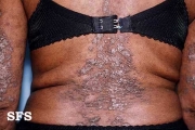 darier's disease