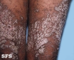 darier's disease