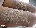 darier's disease
