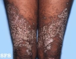 darier's disease