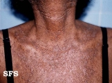 darier's disease