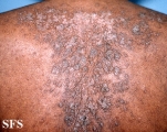 darier's disease