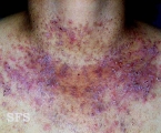darier's disease