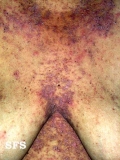 darier's disease