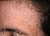 darier's disease