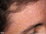 darier's disease