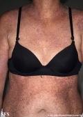 darier's disease