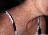 darier's disease