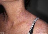 darier's disease