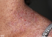darier's disease