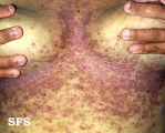 darier's disease