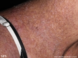 darier's disease
