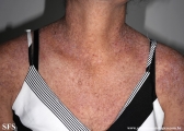 darier's disease