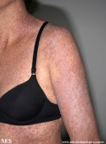 darier's disease