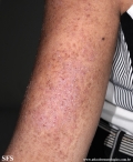 darier's disease