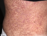 darier's disease