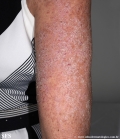 darier's disease