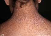 darier's disease