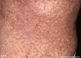 darier's disease