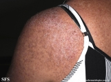 darier's disease