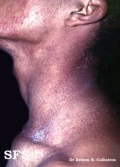 darier's disease