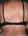 darier's disease