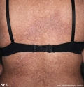 darier's disease