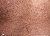 darier's disease