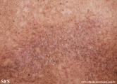 darier's disease