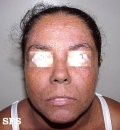 darier's disease