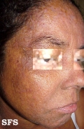 darier's disease