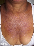 darier's disease
