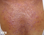 darier's disease