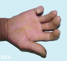 darier's disease