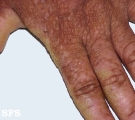 darier's disease