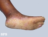 darier's disease