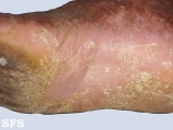darier's disease