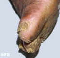 darier's disease