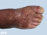 darier's disease