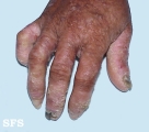 darier's disease