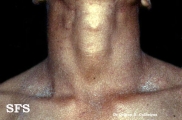 darier's disease