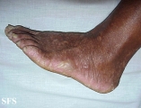 darier's disease