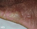 darier's disease
