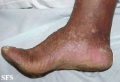 darier's disease