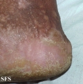 darier's disease