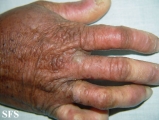 darier's disease