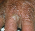 darier's disease