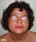 darier's disease