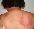 darier's disease