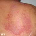 darier's disease